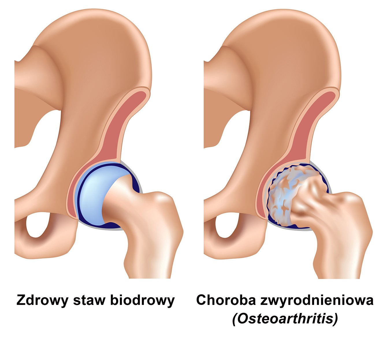 ortopeda osteoartroza staw biodrow